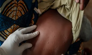 The Ministry of Health: MPOX Vaccine Has Been Approved by WHO and BPOM